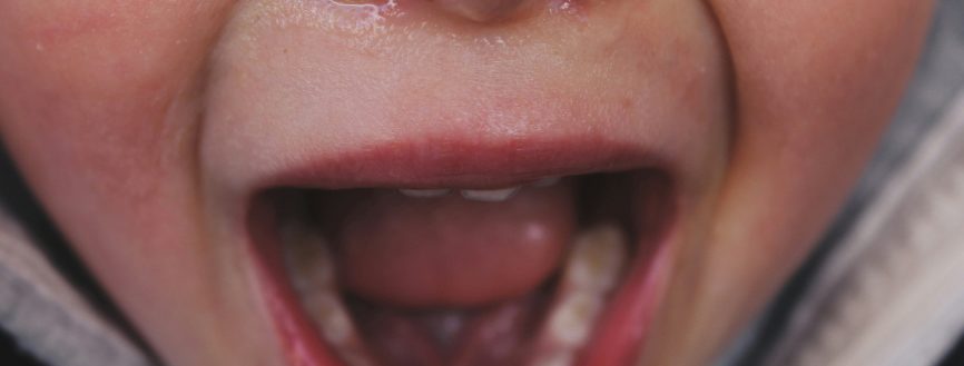 L’EMDR comme complément à la gestion de la douleur lors d'une extraction dentaire chez l'enfant