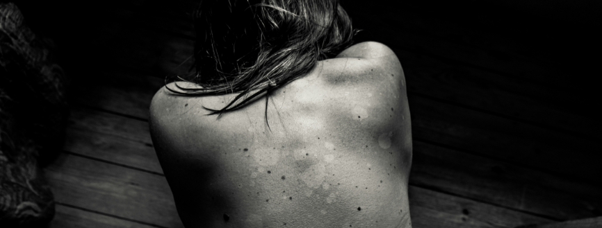 Augmentation de l'EMDR avec la stimulation transcrânienne multifocale (MtCS) dans le traitement de la fibromyalgie