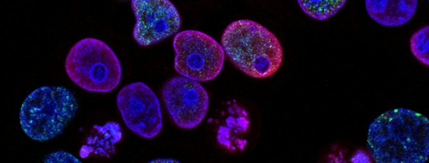 Cancer, trauma et menace persistante : considérations cliniques pour adapter l'EMDR en oncologie